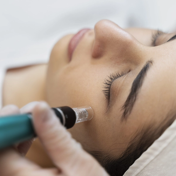 Dermapen u salonu Epiderma