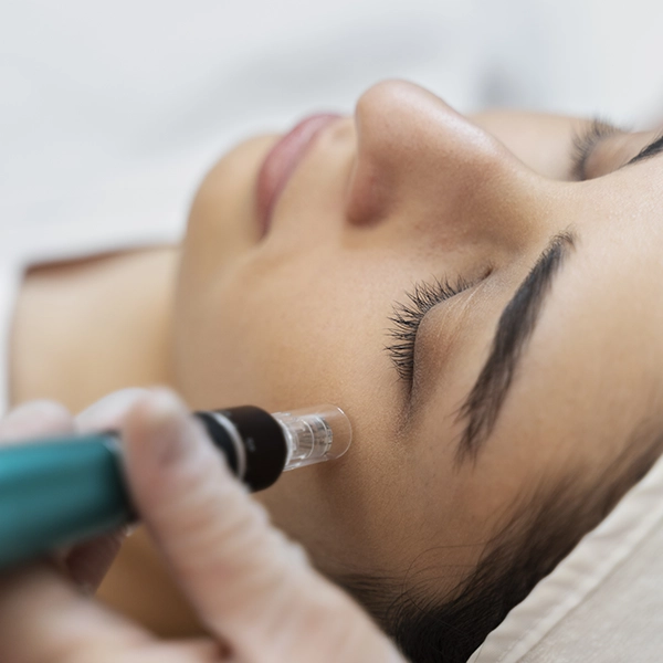 Dermapen u nasem salonu